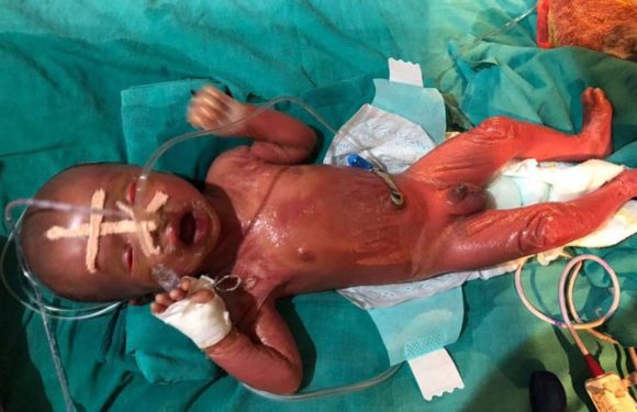 कोलोडियन बेबी देख चौकें चिकित्सक,प्लास्टिक जैसी है बच्चे की स्किन