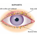 blepharitis
