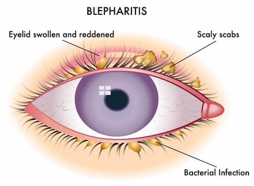 Blepharitis- आखिर कैसे होती है पलकों में सूजन? जानें इसके लक्षण और कारण