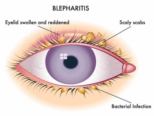 Blepharitis- आखिर कैसे होती है पलकों में सूजन? जानें इसके लक्षण और कारण