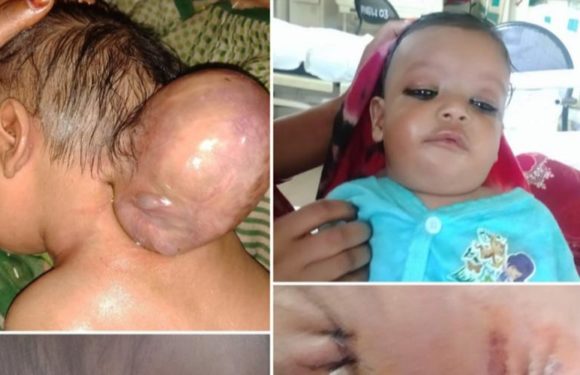 दो सिर वाले नवजात शिशु का सैफई मेडिकल कालेज में हुआ सफल आप्रेशन